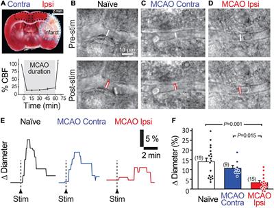 Increased 20-HETE Signaling Suppresses Capillary Neurovascular Coupling After Ischemic Stroke in Regions Beyond the Infarct